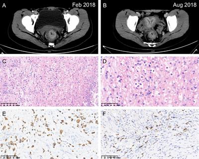 Case Report: Systemic treatment for breast and vulvar metastases from resected rectal signet ring cell carcinoma